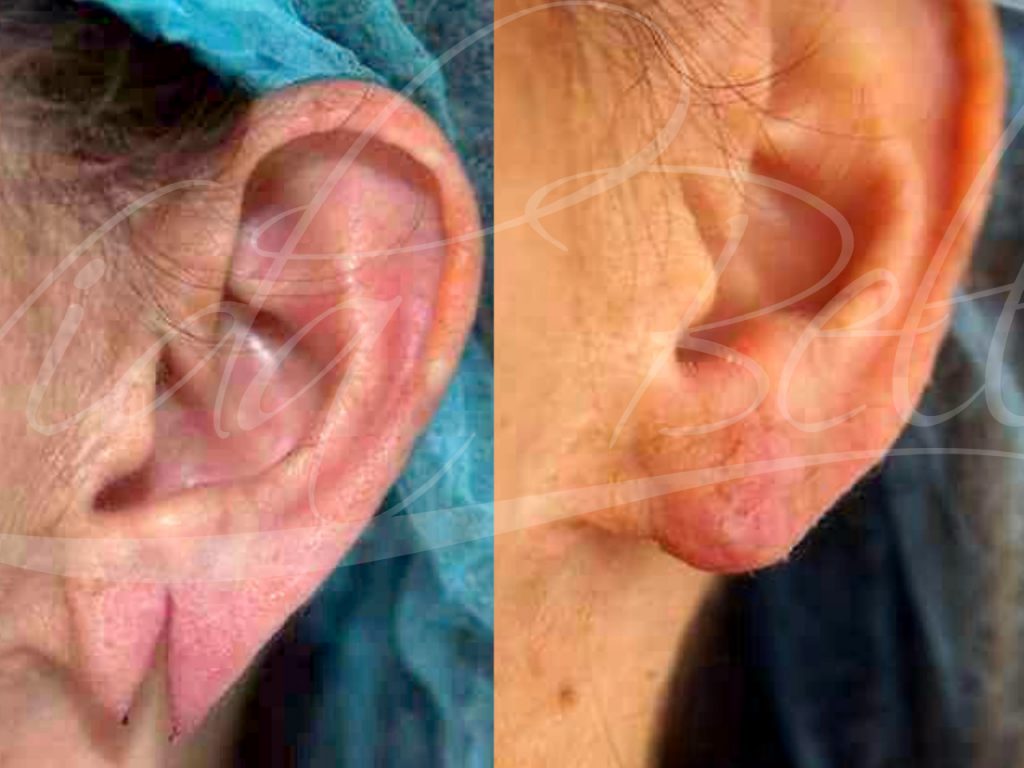 vidabella procedimientos menores oreja rasgada