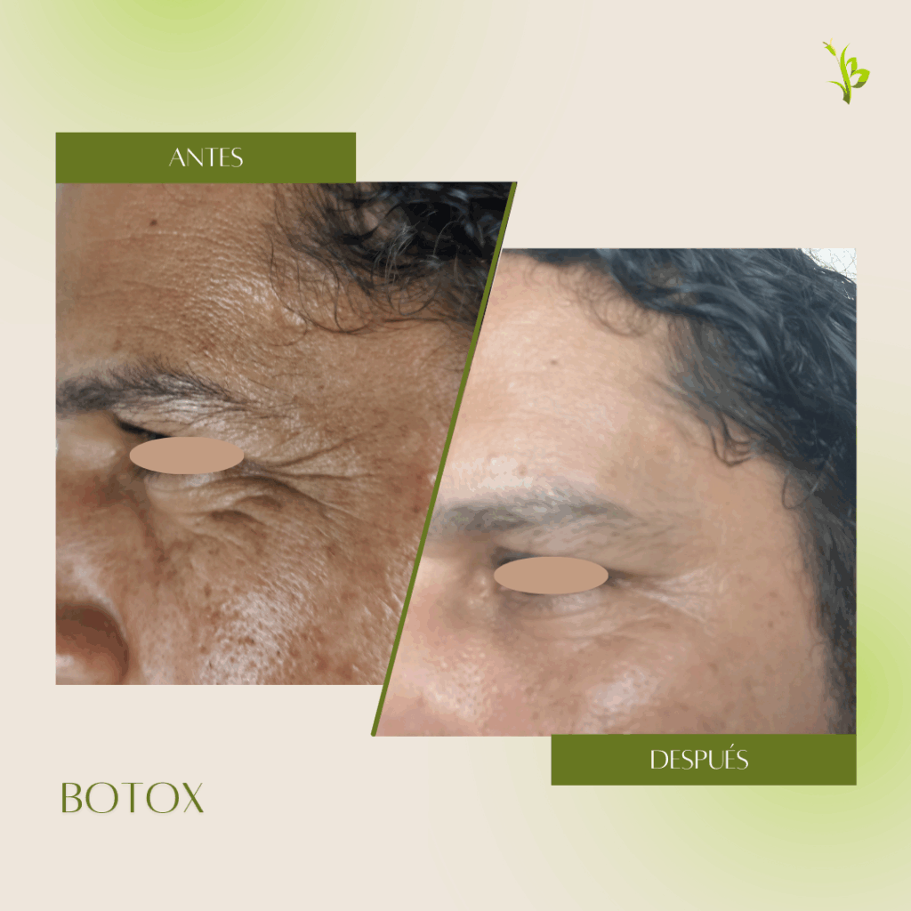 botox