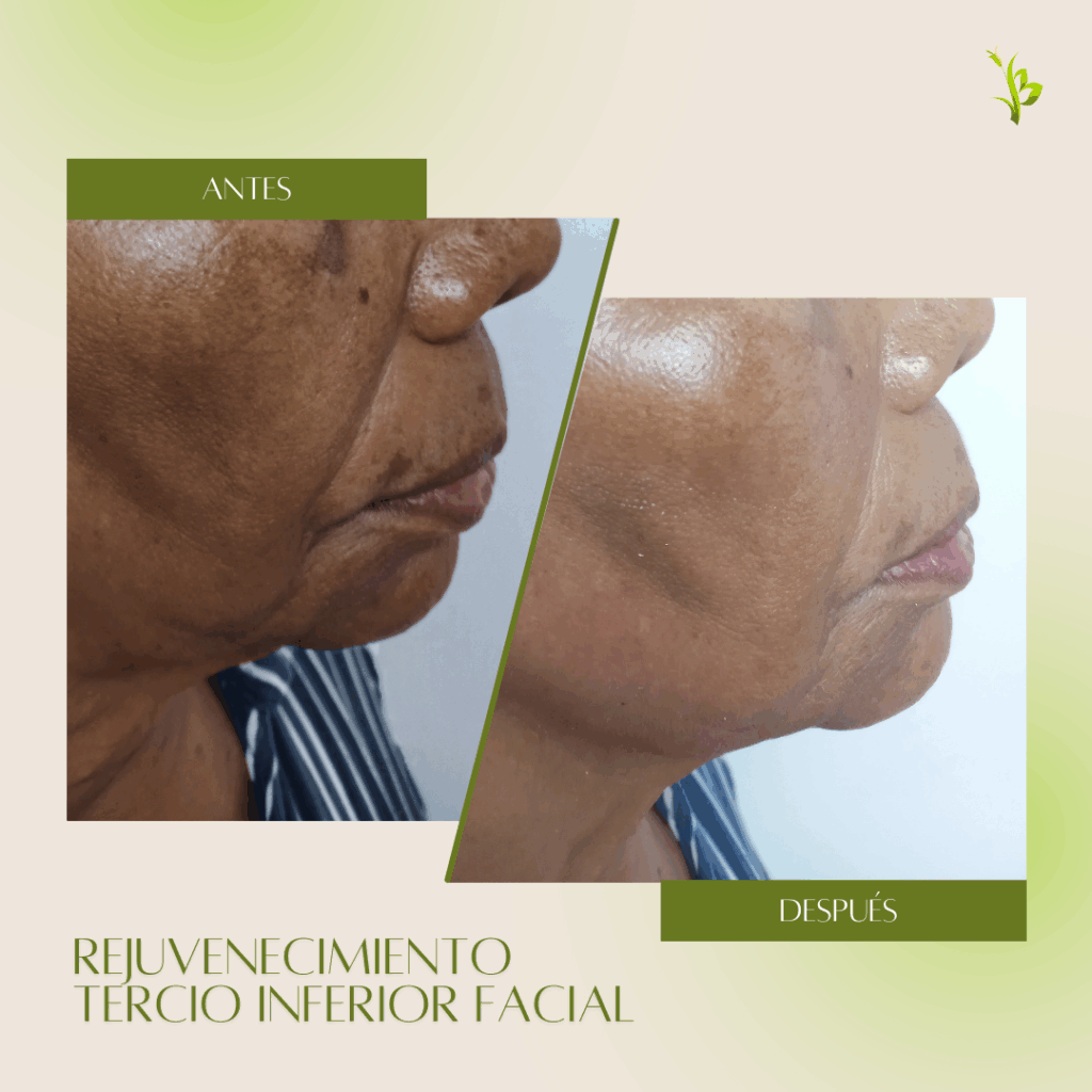 rejuvenicimiento tercio inferior facial